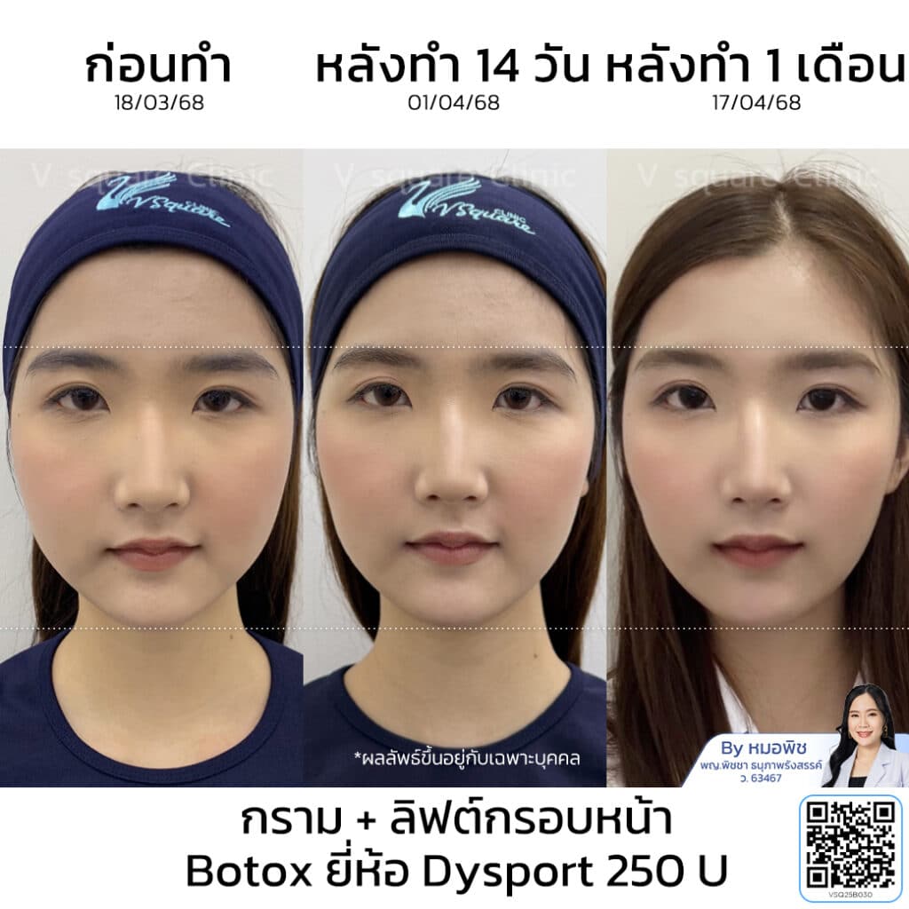 รีวิวโบท็อก Dysport_คุณคาโอริ_โดยหมอพิช