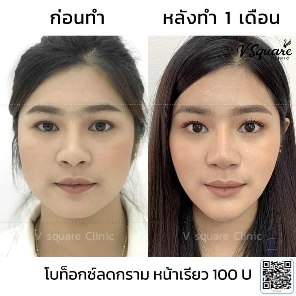 รีวิวโบท็อกซ์ Xeomin ลดกราม_พี่พลอย (ชี)