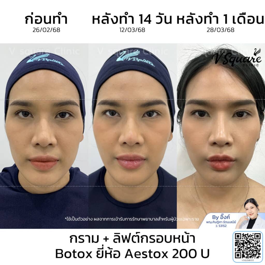 โบท็อก Aestox รีวิว_กุญแจซอล_โดยหมออิ๊งค์