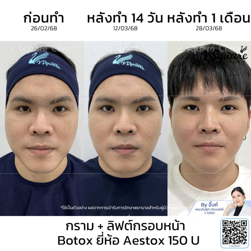 โบท็อก Aestox รีวิว_น้องตะลัน_โดยหมออิ๊งค์