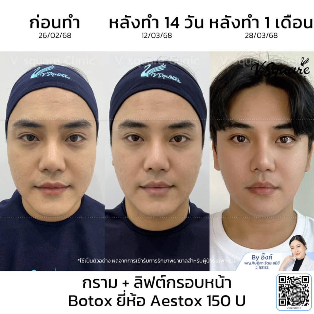 โบท็อก Aestox รีวิว_โย_โดยหมออิ๊งค์