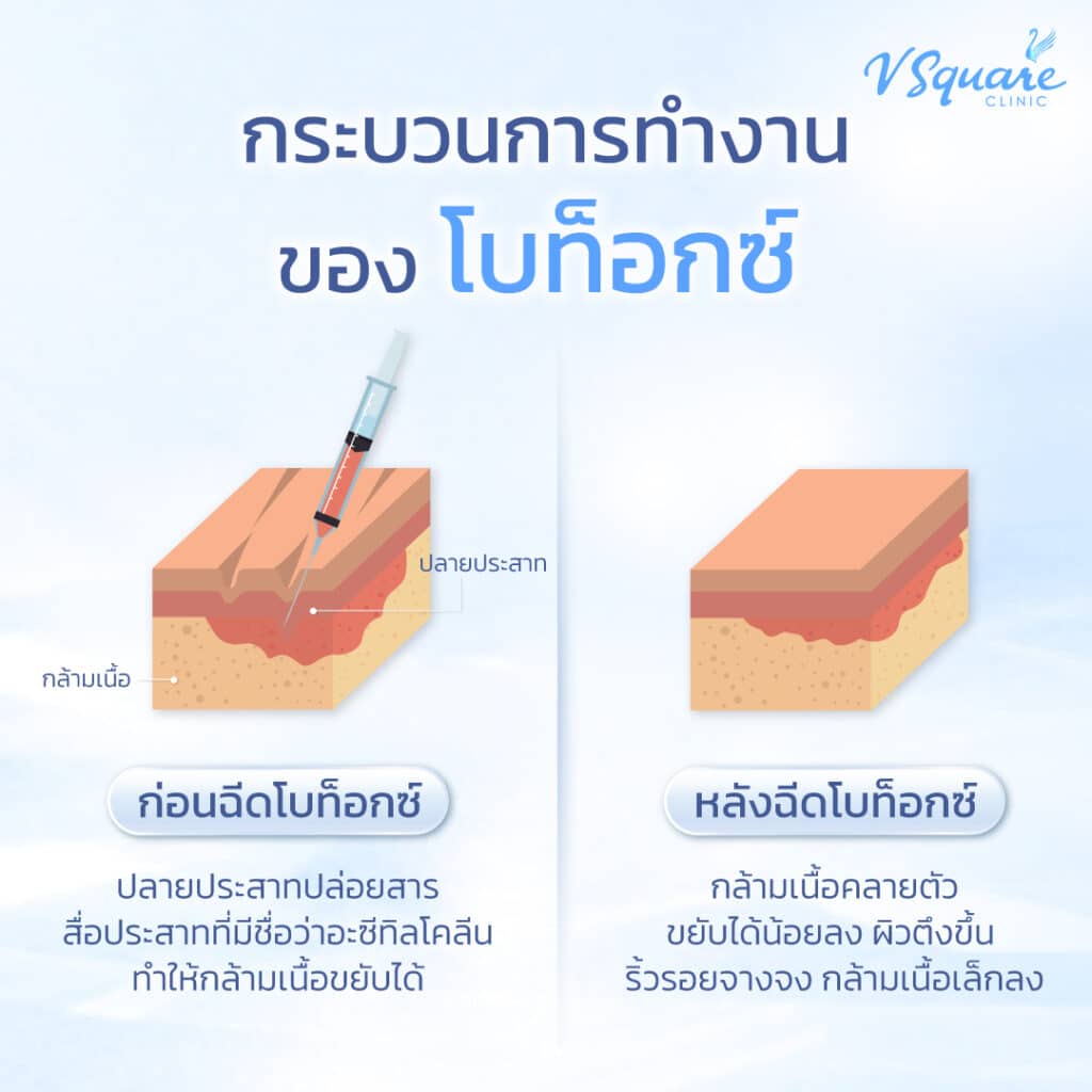 กลไกการทำงานโบท็อกตีนกา