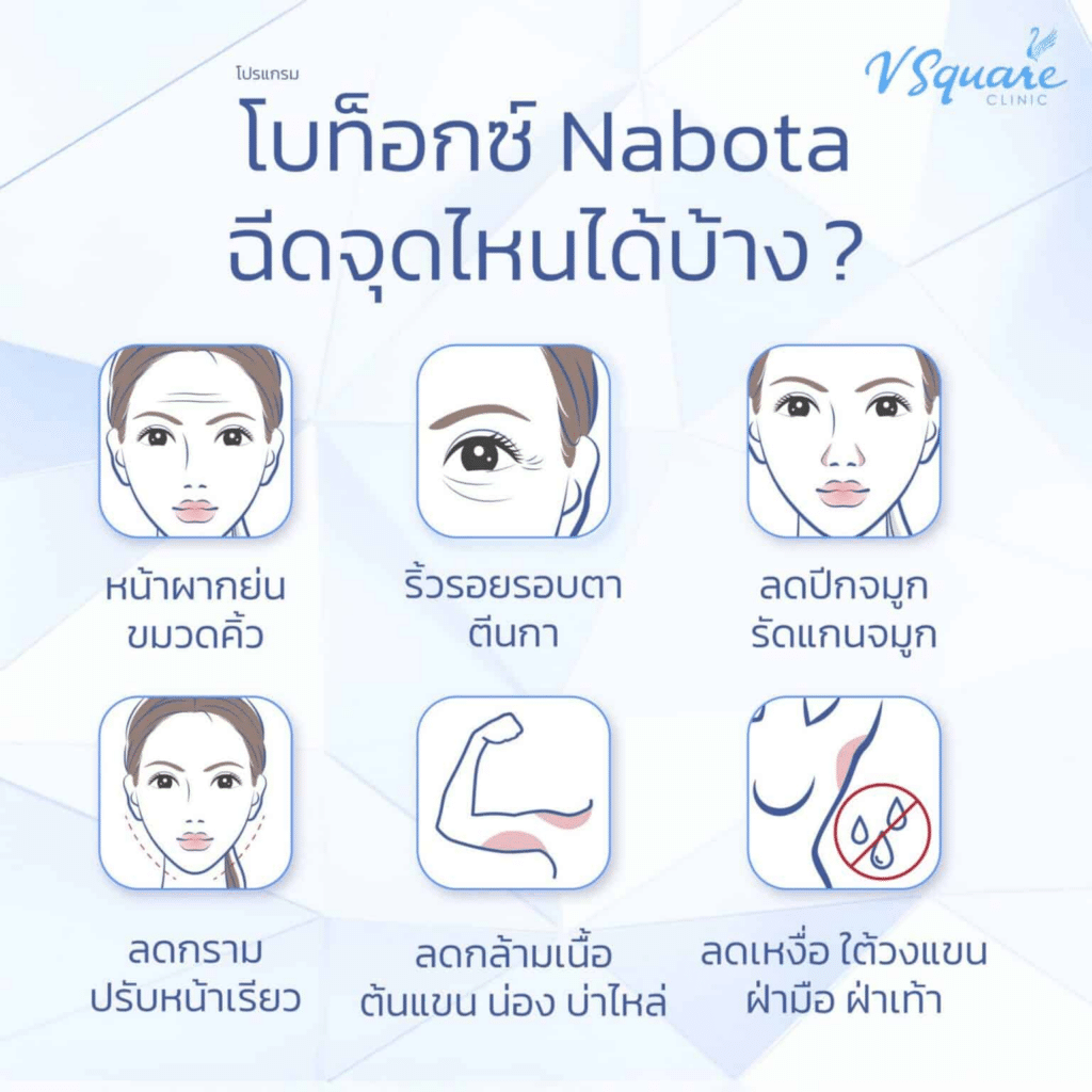 ตำแหน่งฉีด Nabota botox