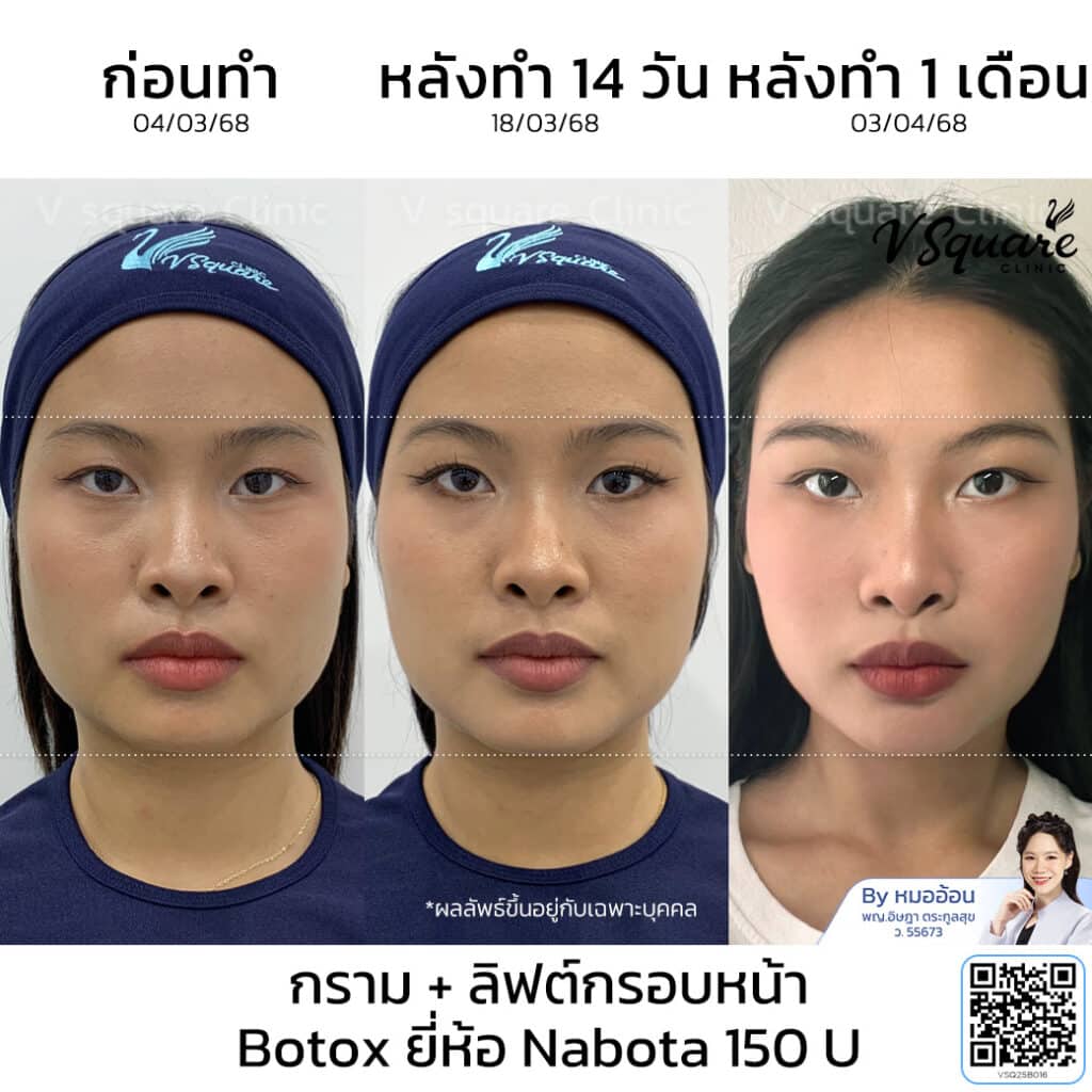 รีวิวฉีด Nabota ลดกราม ลิฟกรอบหน้า_คุณญานิน_โดยหมออ้อน