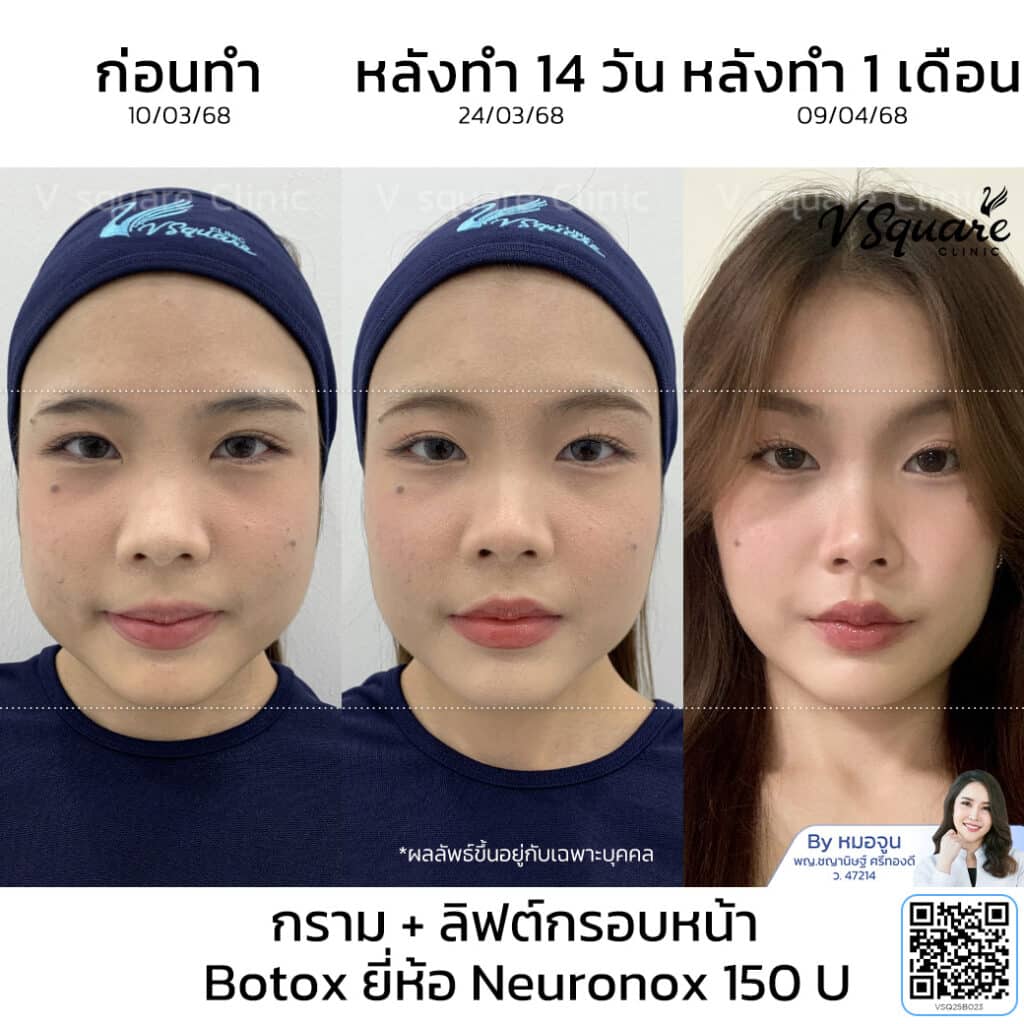 รีวิวฉีด Neuronox ลดกราม ลิฟกรอบหน้า_คุณนิชา_โดยหมอจูน