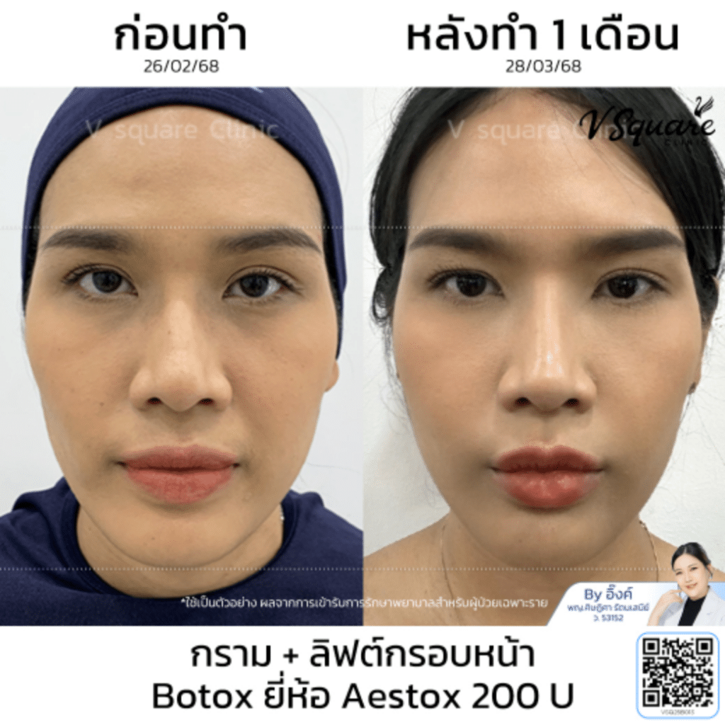 รีวิวฉีด aestox ดีไหม_กุญแจซอล_โดยหมออิ๊งค์