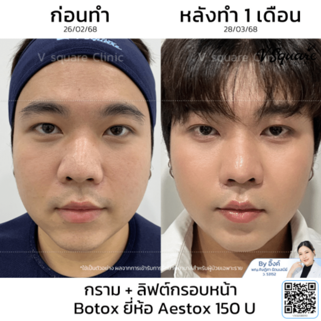 รีวิวฉีด aestox ดีไหม_คุณรุ่ง_โดยหมออิ๊งค์
