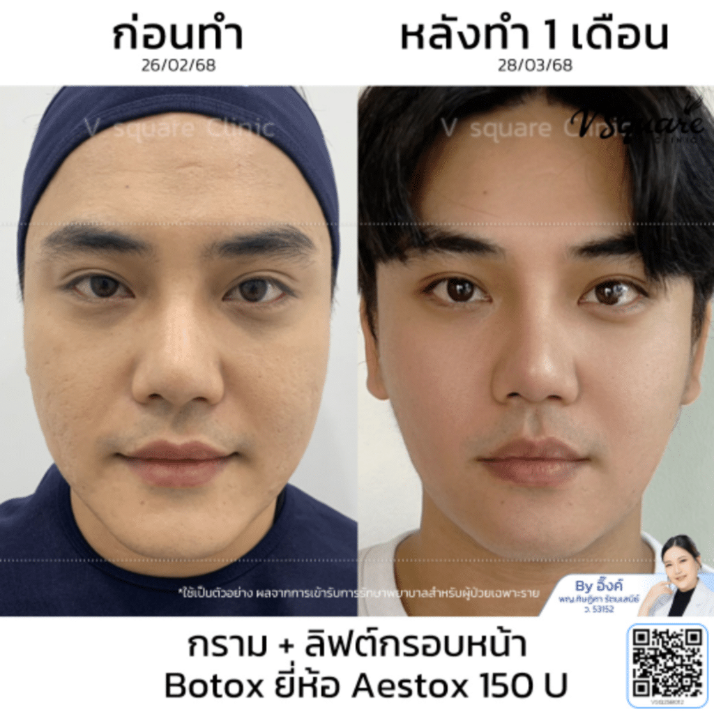 รีวิวฉีด aestox ดีไหม_โย_โดยหมออิ๊งค์