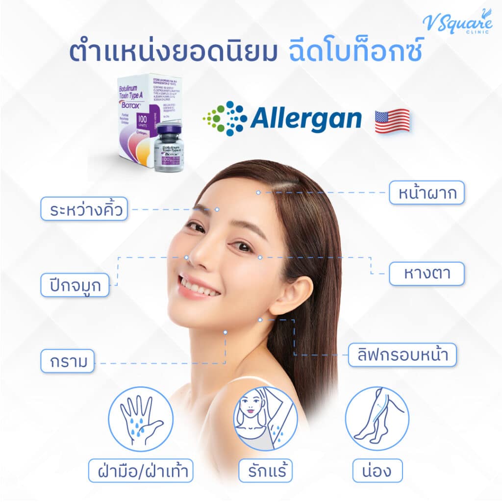 โบท็อก Allergan ฉีดตำแหน่งไหน