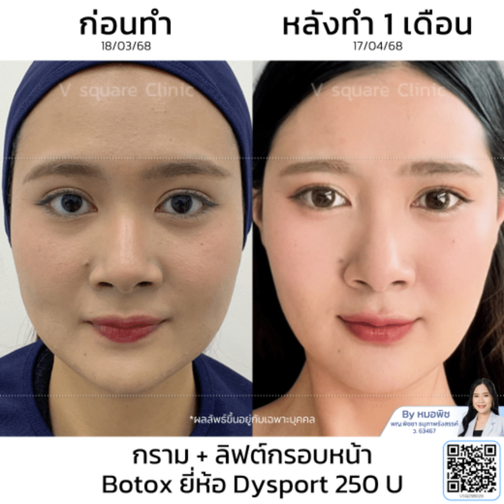 รีวิว Dysport botox ราคา_คุณฟ้า_โดยหมอพิช
