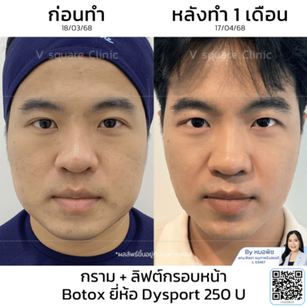 รีวิว Dysport botox ราคา_คุณเก้า_โดยหมอพิช
