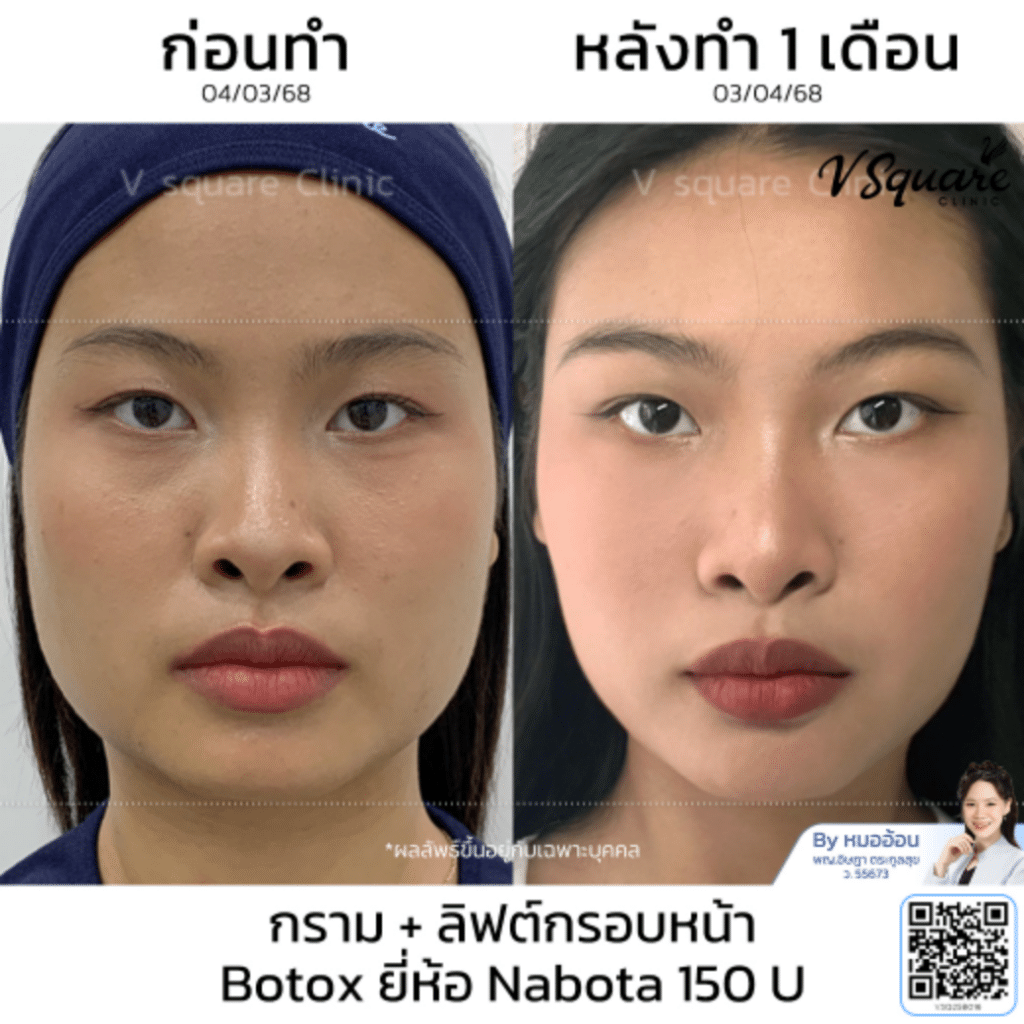 nabota_คุณญานิน_โดยหมออ้อน