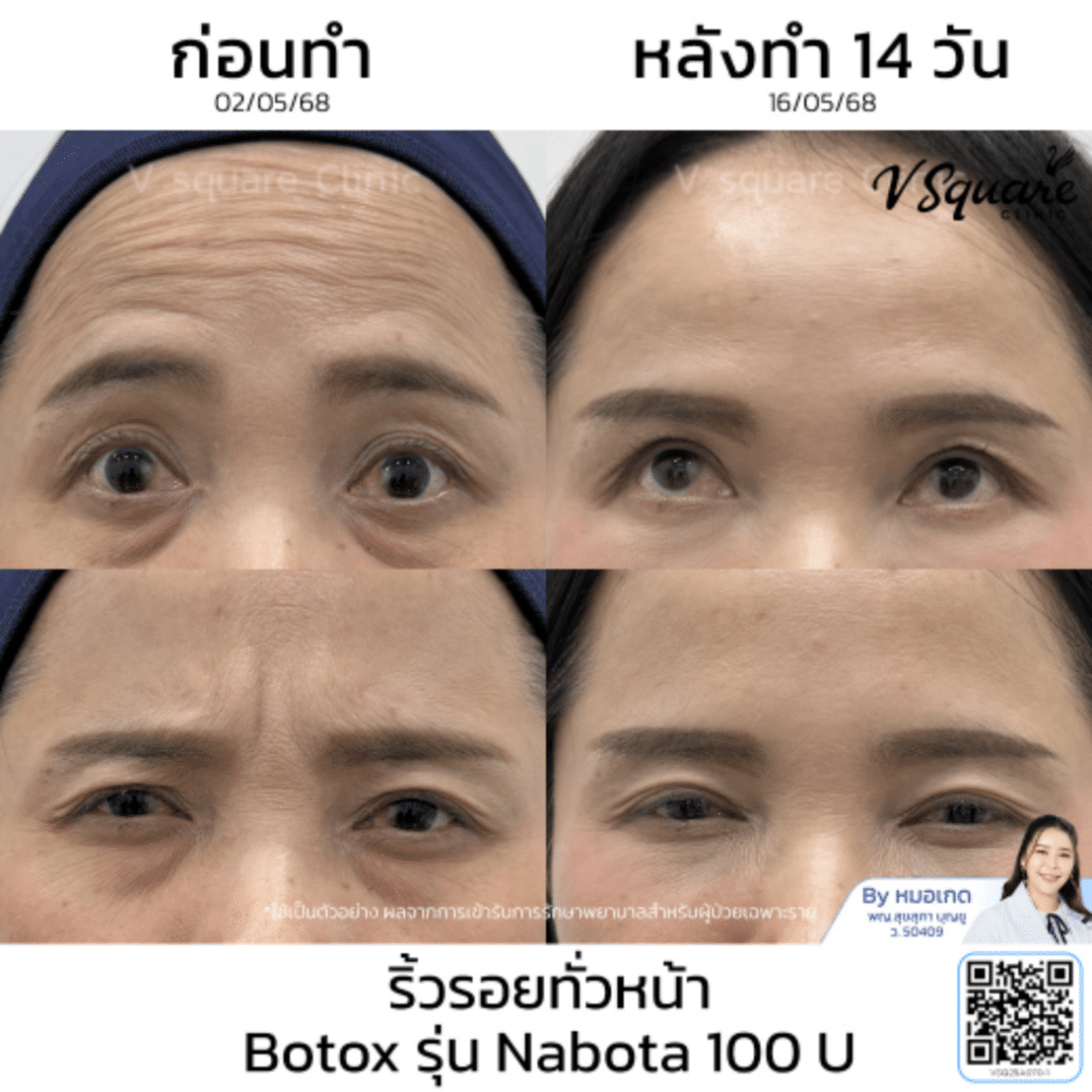 nabota_คุณเนตร_โดยหมอเกด