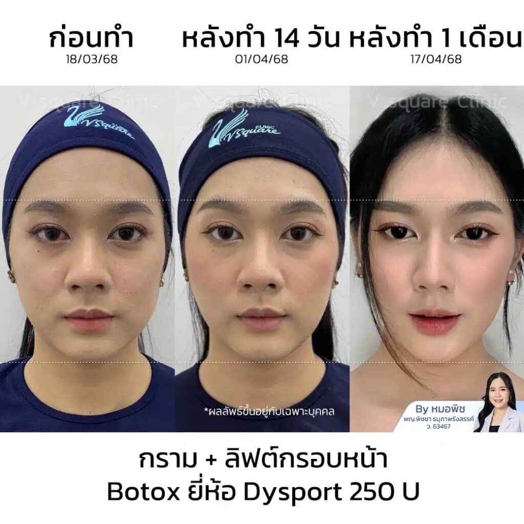 รีวิวโบลดกราม_ยาหยี_โดยหมอพิช