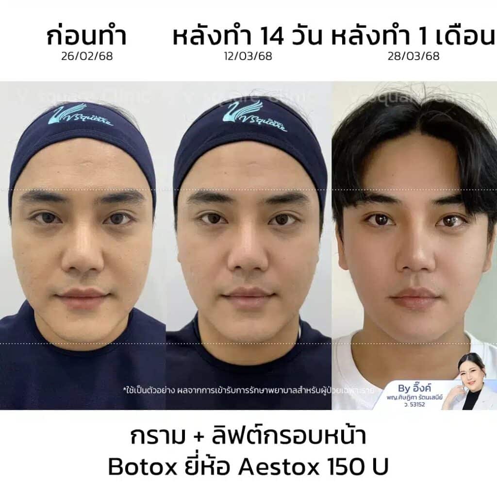 รีวิวโบลดกราม_โย_โดยหมออิ๊งค์