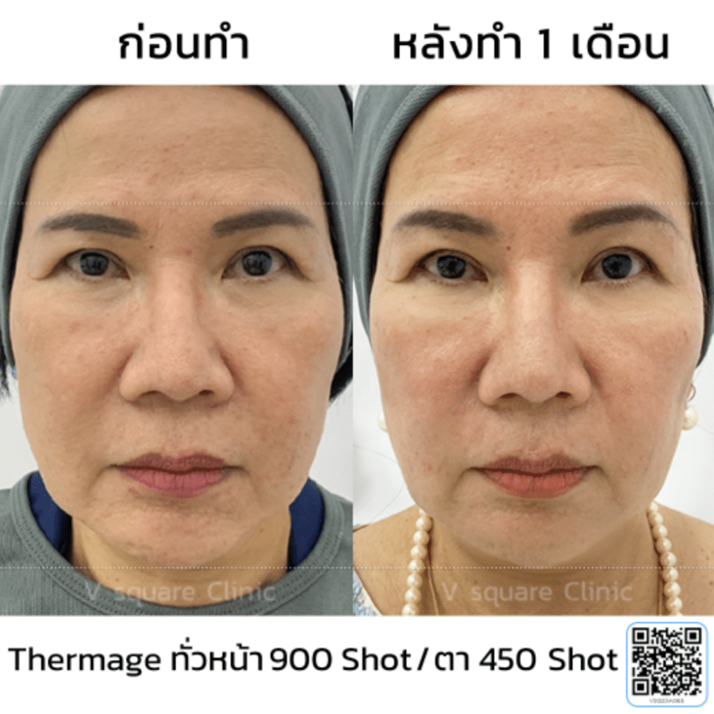 รีวิว Thermage หน้าบวมกี่วัน_แม่อ๋อย