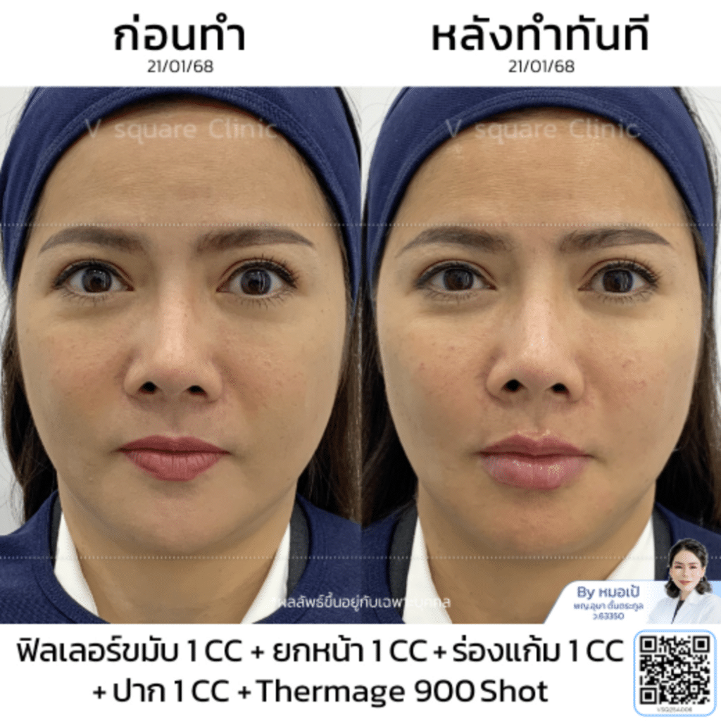 หลังทำ Thermage หน้าบวมกี่วัน_พี่ปุ้ย_โดยหมอเป้